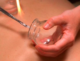 Cupping Therapy